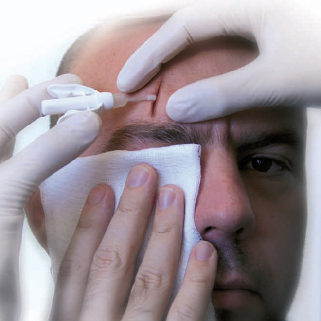 Wound healing outcomes after laceration repair with adhesive