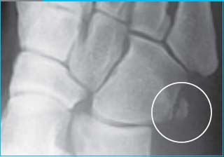 accessory-cuboid-os-peroneum