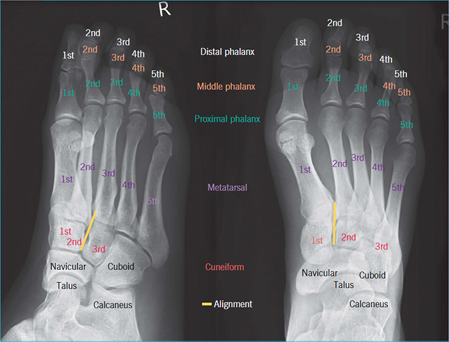 Foot Fracture Xray View