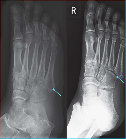 Foot Fracture Xray View