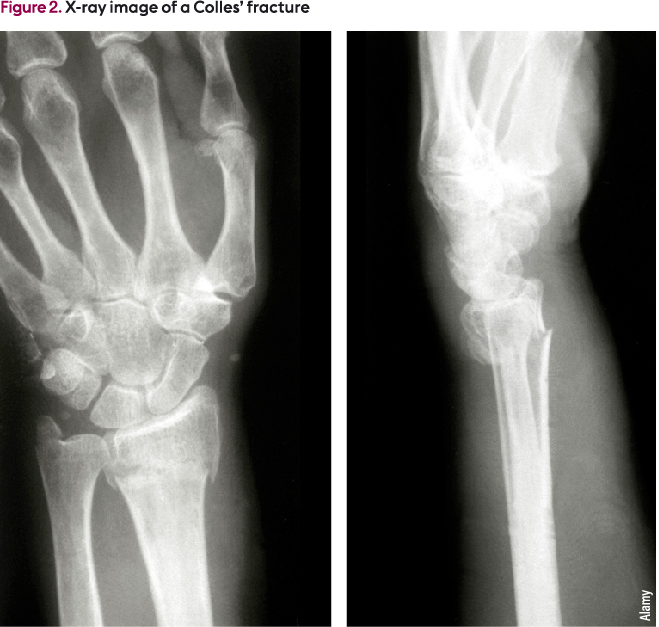 Colles Fracture Plate Colles Fracture X Ray Features