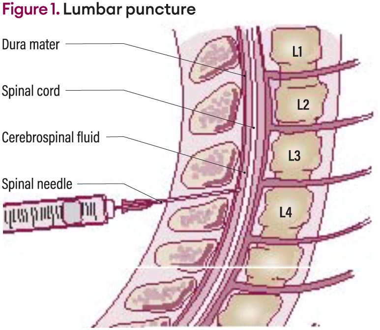 One Punctures Lumbar Puncture Nurses Zone Source Of Resources For Nurses