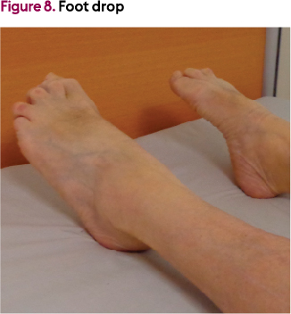 Prevention Of Contractures In Older People Living In Long Term