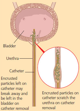 Inflate Balloon Catheter