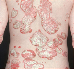 hydromol ointment bnf