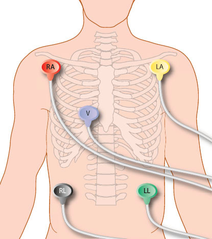 Heart Monitor 5 Lead Placement