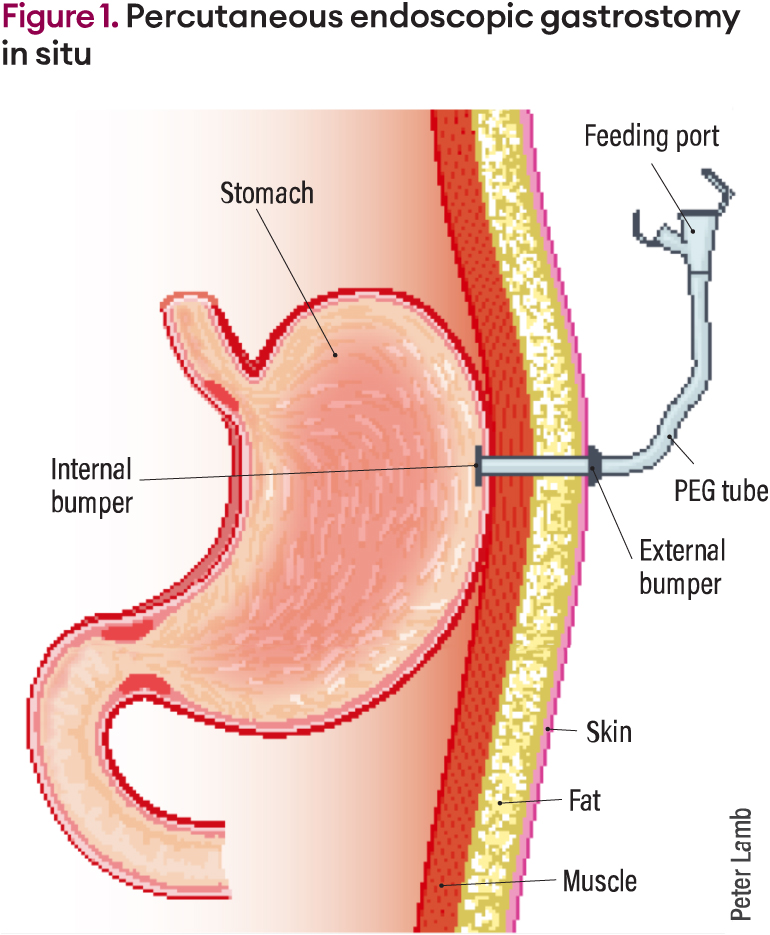 Peg Graphics Percutaneous Endoscopic Gastrostomy Peg A Practical Gastrostomy Tube