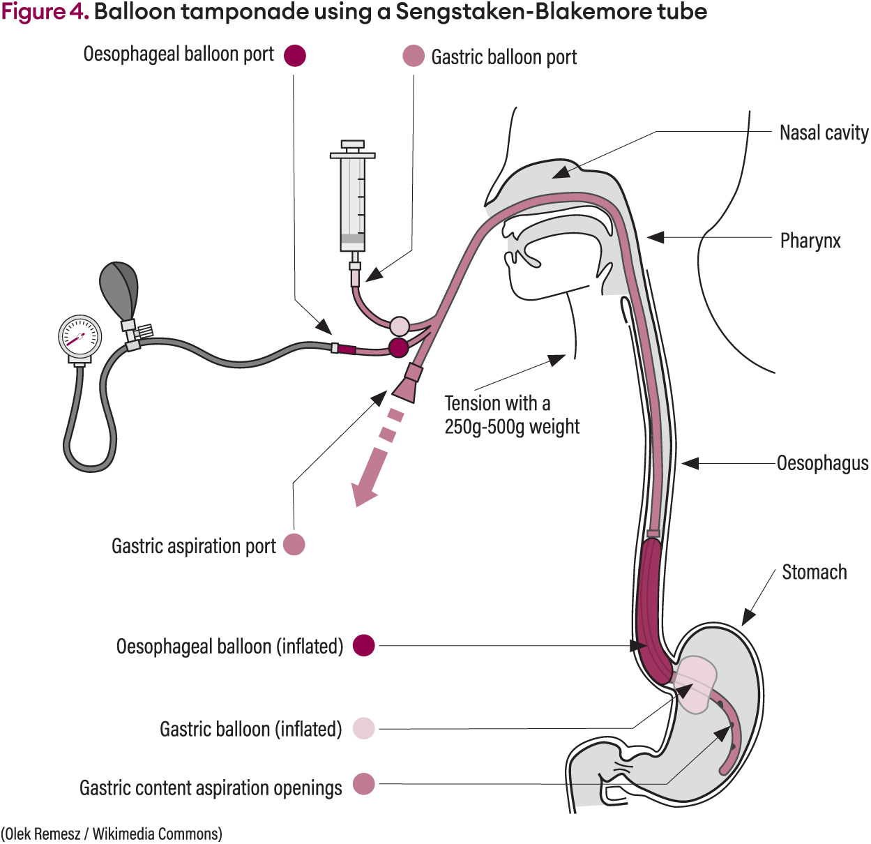 Varices Pathogenesis Portal Hypertension Varices Pathophysiology