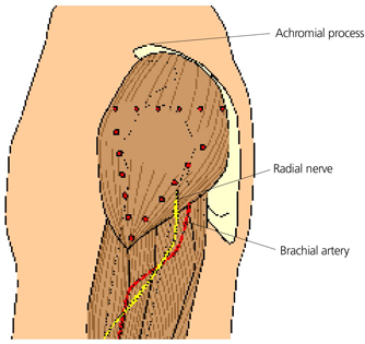 Delmus Injection Intramuscular Injection Deltoid Landmarks