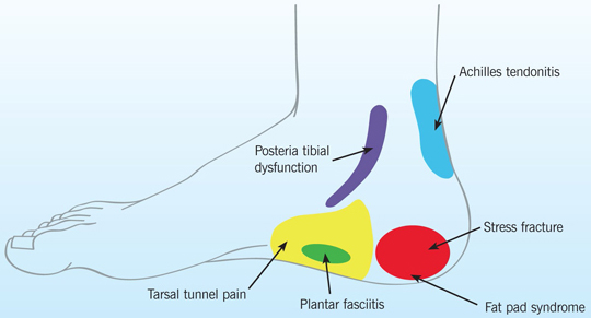 A Guide To The Recognition And Treatment Of Plantar Fasciitis